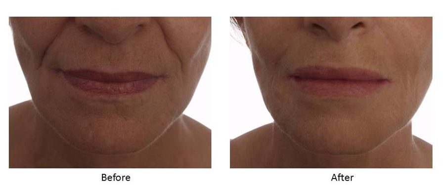 Before and after — Wrinkle Solution, real patient of Dr. Sevinor’s practice