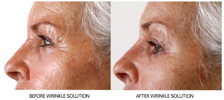 Before and after — Wrinkle Solution, real patient of Dr. Sevinor’s practice