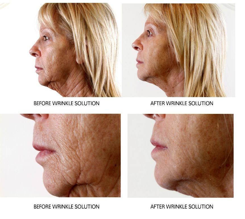 Before and after — Wrinkle Solution, real patient of Dr. Sevinor’s practice