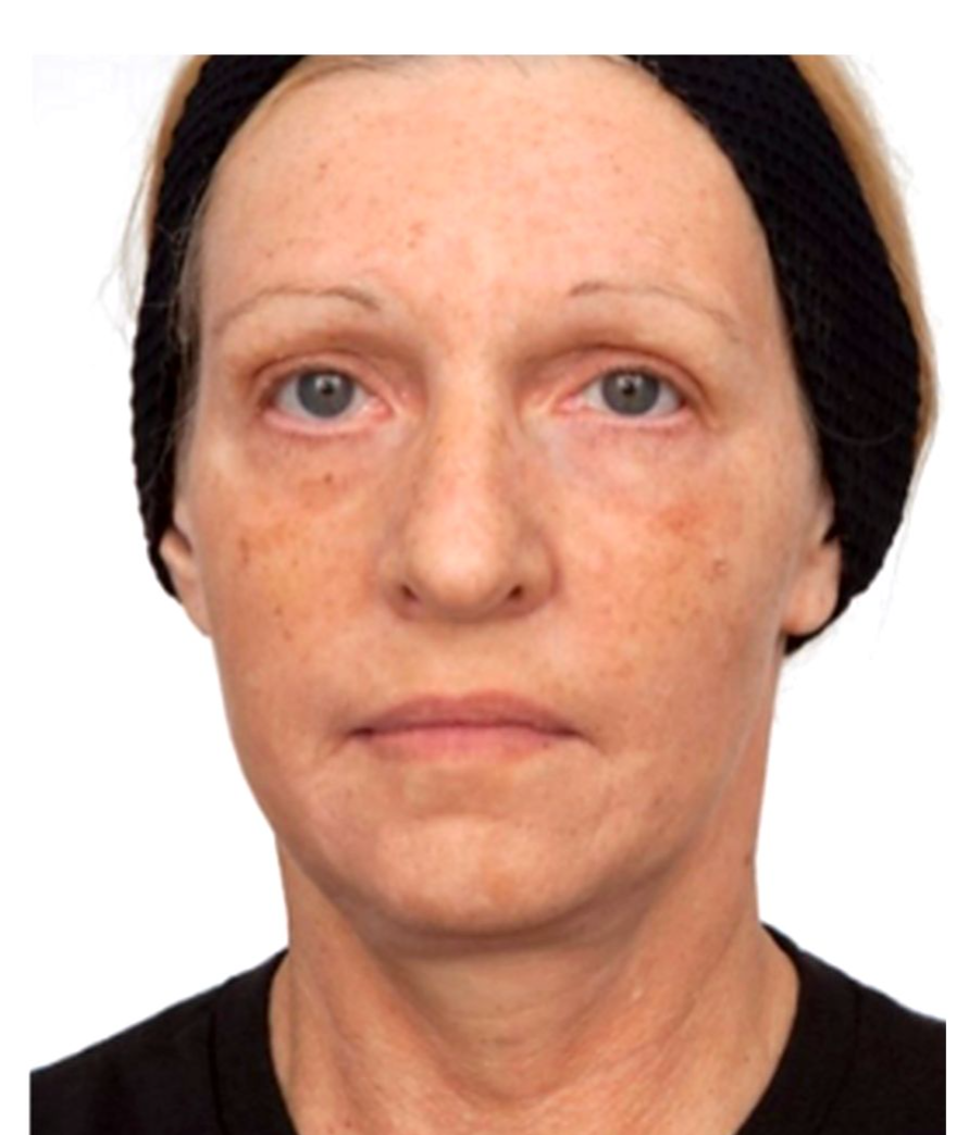 After treatment