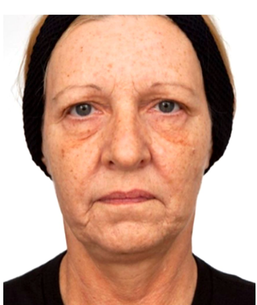 Before treatment
