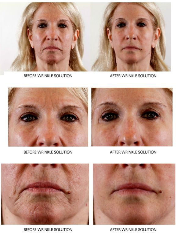 Before and after — Wrinkle Solution, real patient of Dr. Sevinor&rsquo;s practice