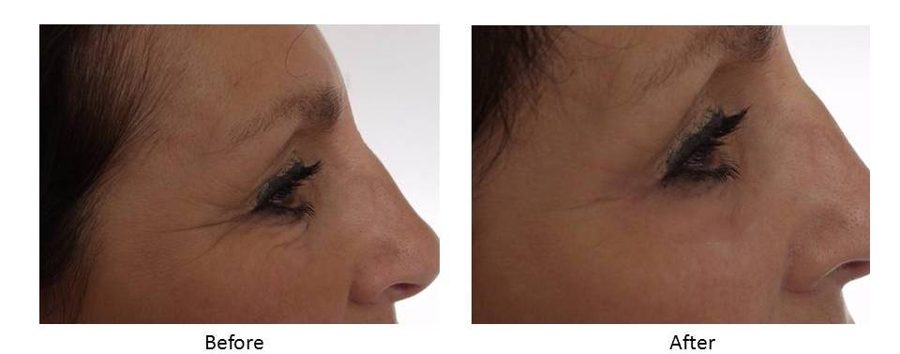 Before and after — Wrinkle Solution, real patient of Dr. Sevinor&rsquo;s practice