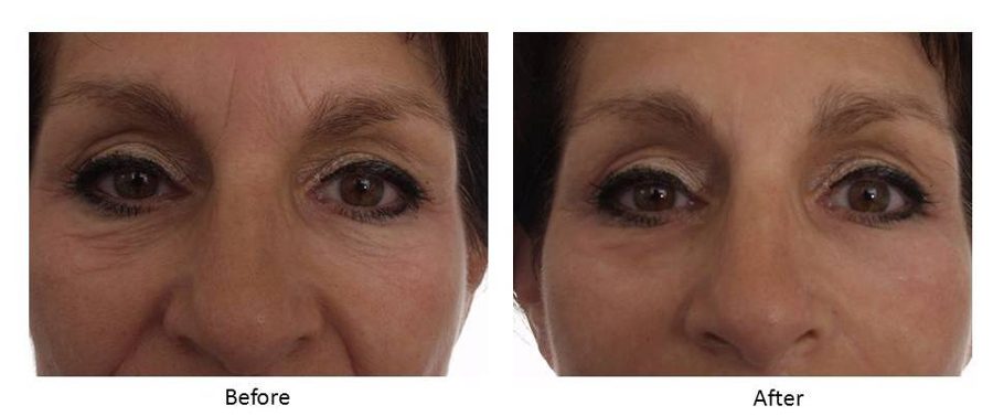 Before and after — Wrinkle Solution, real patient of Dr. Sevinor&rsquo;s practice