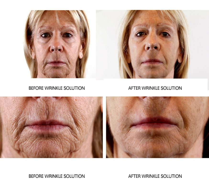 Before and after — Wrinkle Solution, real patient of Dr. Sevinor&rsquo;s practice