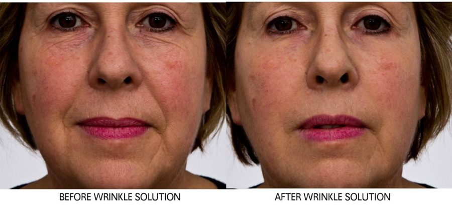 Before and after — Wrinkle Solution, real patient of Dr. Sevinor&rsquo;s practice