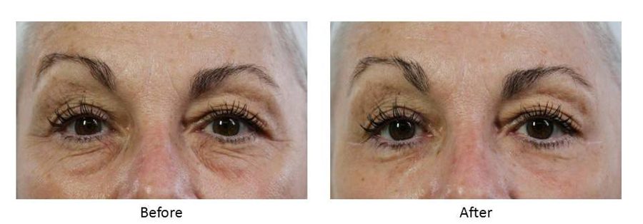 Before and after — Wrinkle Solution, real patient of Dr. Sevinor&rsquo;s practice